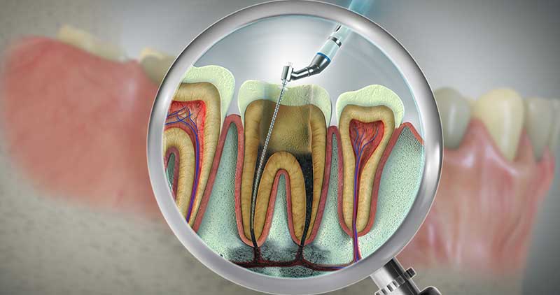 Do I Need a Crown After a Root Canal?