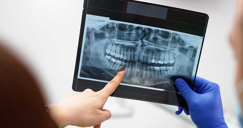 Is It Safe to Get Dental X-Rays?