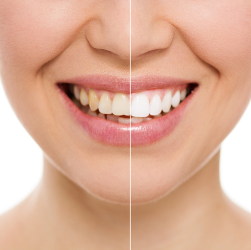 The Advantages of Professional Teeth Whitening