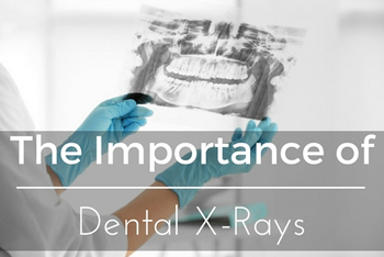 The Importance of Dental X-Rays