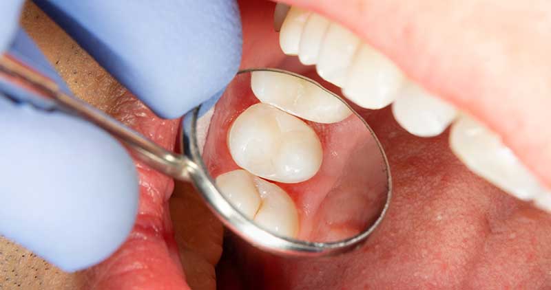 Preventing Tooth Decay: Tips for Maintaining a Healthy Smile