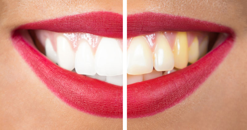 Can Yellow Teeth Become White?