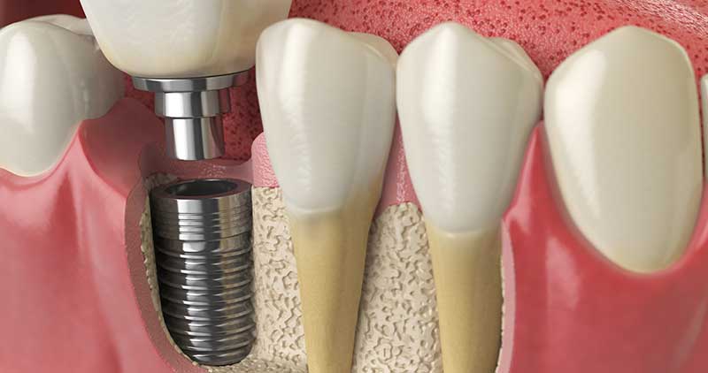 Do Dental Implants Cause Bad Breath?