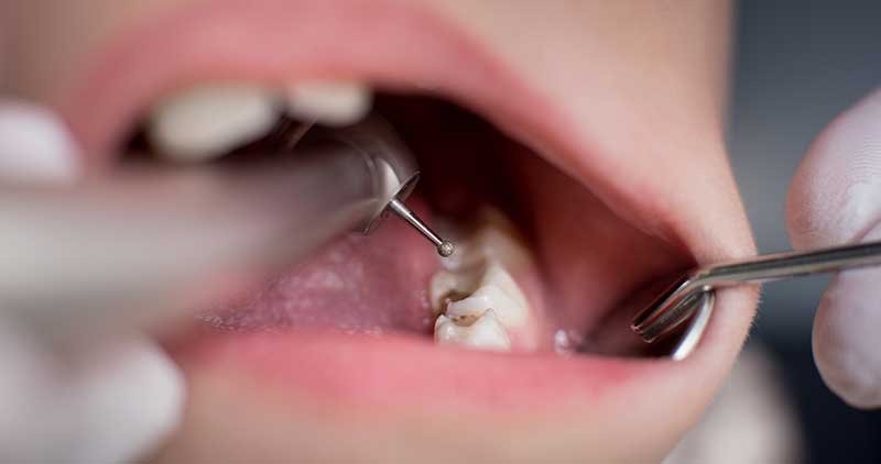 Does Tooth Decay Shorten One’s Lifespan?