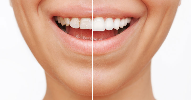 How Long Do Veneers Last For?