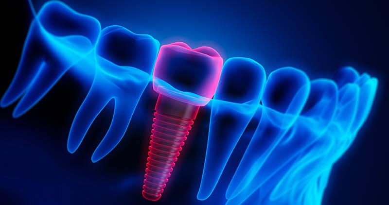 How Long Does It Take to Recover from a Dental Implant?
