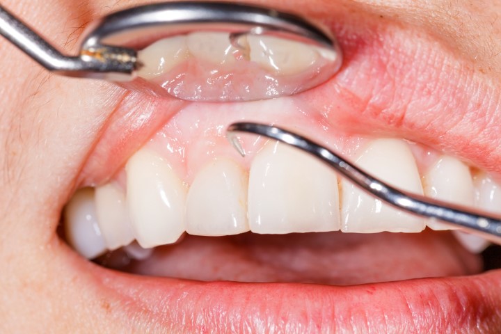 signs of gum disease