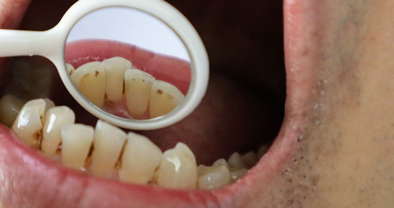 Understanding Gum Disease: Causes, Symptoms and Prevention