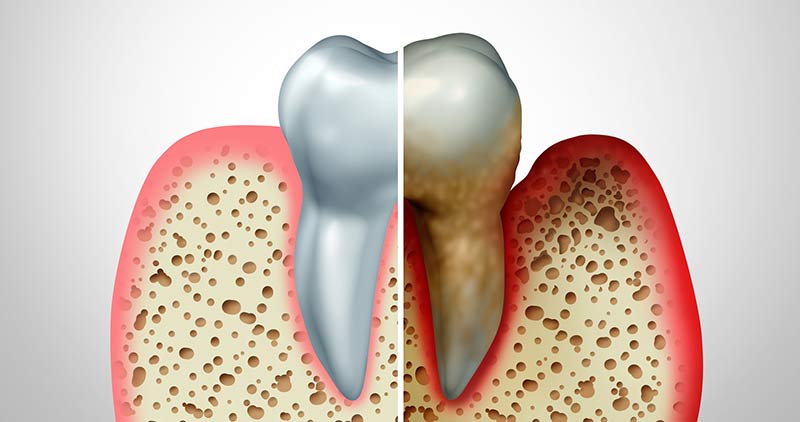 Gum Disease: Understanding the Causes and Treatment Options