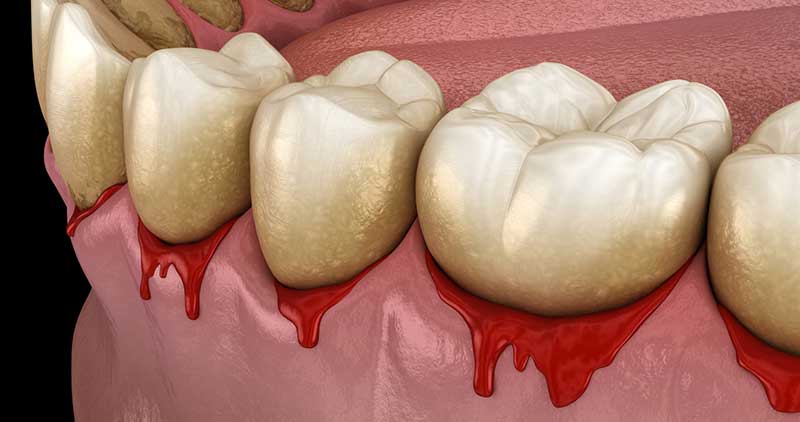 What Are the Symptoms of Gum Disease?