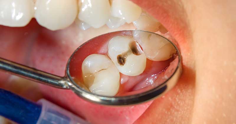 What Can Cause Rapid Tooth Decay?
