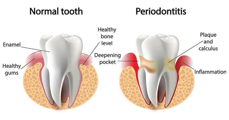 What is Periodontitis